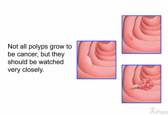 Not all polyps grow to be cancer, but they should be watched very closely.