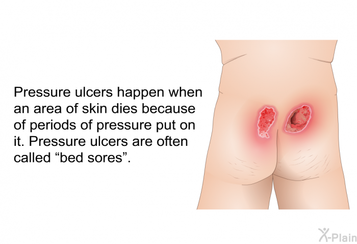 Pressure ulcers happen when an area of skin dies because of periods of pressure put on it. Pressure ulcers are often called “bed sores”.