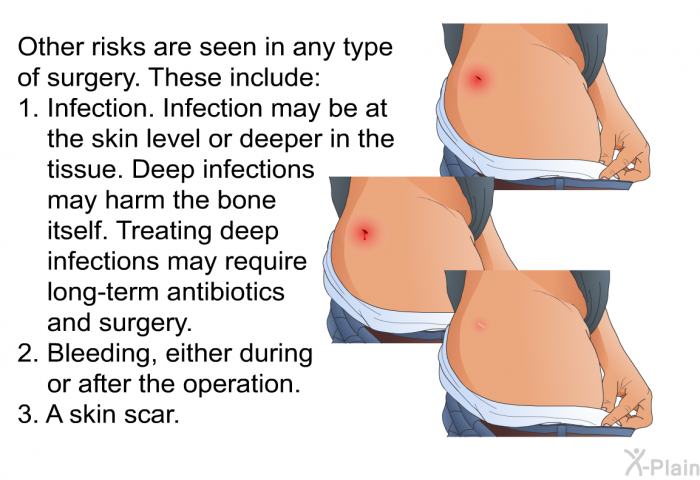 Other risks are seen in any type of surgery. These include:  Infection. Infection may be at the skin level or deeper in the tissue. Deep infections may harm the bone itself. Treating deep infections may require long-term antibiotics and surgery. Bleeding, either during or after the operation. A skin scar.