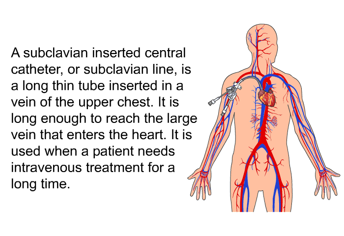 A subclavian inserted central catheter, or subclavian line, is a long thin tube inserted in a vein of the upper chest. It is long enough to reach the large vein that enters the heart. It is used when a patient needs intravenous treatment for a long time.