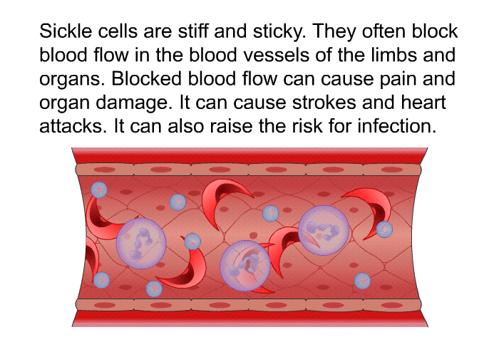Sickle cells are stiff and sticky. They often block blood flow in the blood vessels of the limbs and organs. Blocked blood flow can cause pain and organ damage. It can cause strokes and heart attacks. It can also raise the risk for infection.