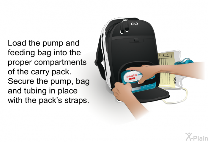 Load the pump and feeding bag into the proper compartments of the carry pack. Secure the pump, bag and tubing in place with the pack's straps.