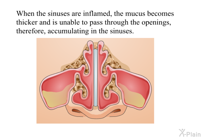 When the sinuses are inflamed, the mucus becomes thicker and is unable to pass through the openings, therefore, accumulating in the sinuses.