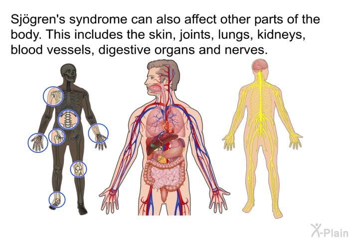Sjögren's syndrome can also affect other parts of the body. This includes the skin, joints, lungs, kidneys, blood vessels, digestive organs and nerves.