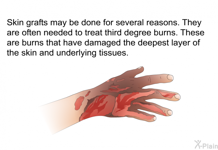 Skin grafts may be done for several reasons. They are often needed to treat third degree burns. These are burns that have damaged the deepest layer of the skin and underlying tissues.