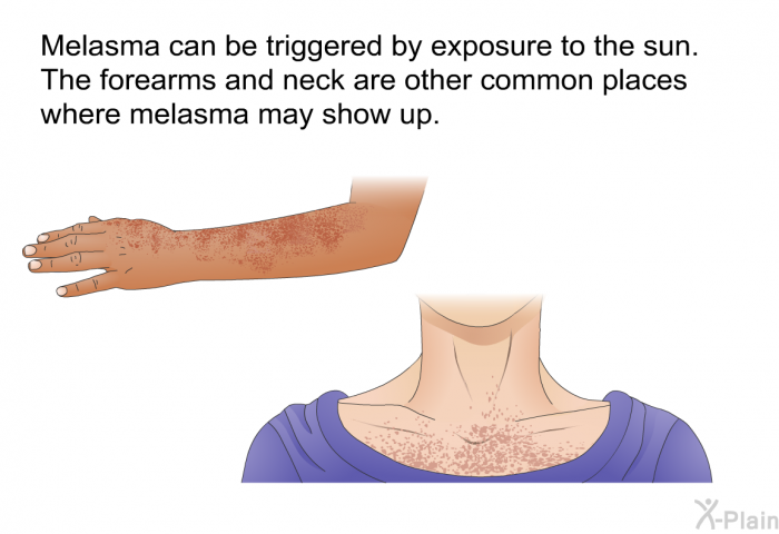 Melasma can be triggered by exposure to the sun. The forearms and neck are other common places where melasma may show up.
