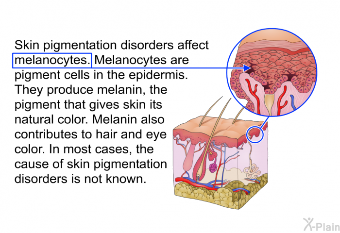 Skin pigmentation disorders affect melanocytes. Melanocytes are pigment cells in the epidermis. They produce melanin, the pigment that gives skin its natural color. Melanin also contributes to hair and eye color. In most cases, the cause of skin pigmentation disorders is not known.