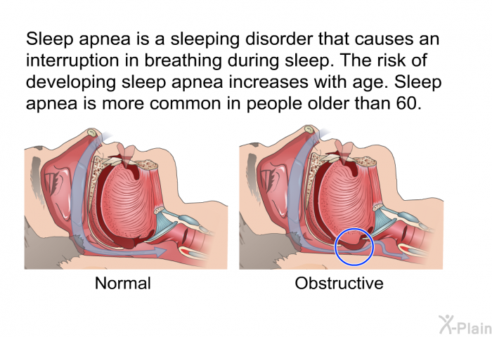Sleep apnea is a sleeping disorder that causes an interruption in breathing during sleep. The risk of developing sleep apnea increases with age. Sleep apnea is more common in people older than 60.