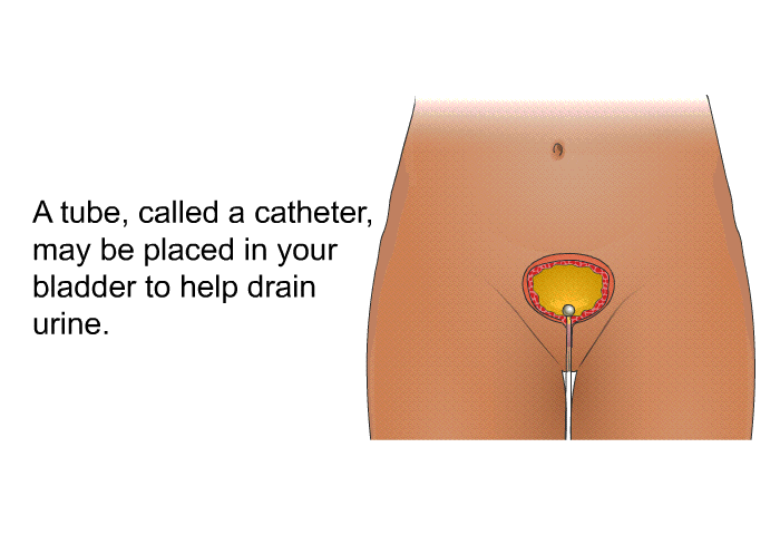 A tube, called a catheter, may be placed in your bladder to help drain urine.