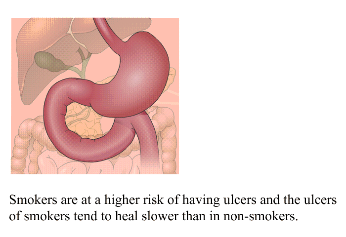 Smokers are at a higher risk of having ulcers and the ulcers of smokers tend to heal slower than in non-smokers.