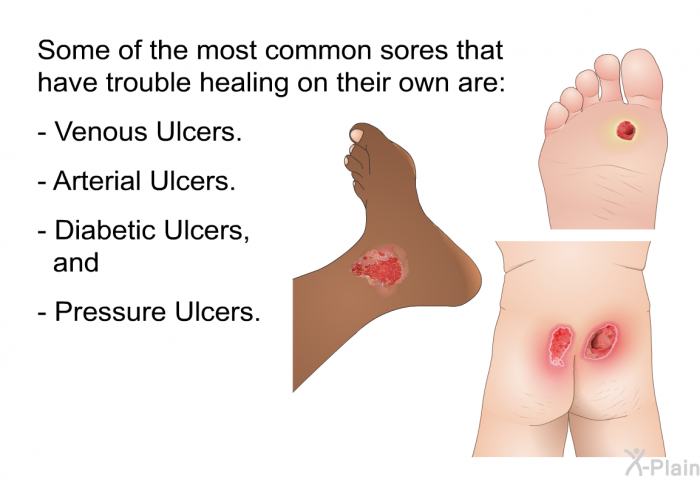 Some of the most common sores that have trouble healing on their own are:  Venous Ulcers. Arterial Ulcers. Diabetic Ulcers, and Pressure Ulcers.