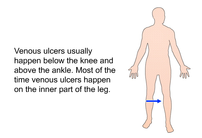 Venous ulcers usually happen below the knee and above the ankle. Most of the time venous ulcers happen on the inner part of the leg.