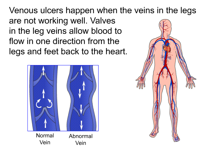 Venous ulcers happen when the veins in the legs are not working well. Valves in the leg veins allow blood to flow in one direction from the legs and feet back to the heart.