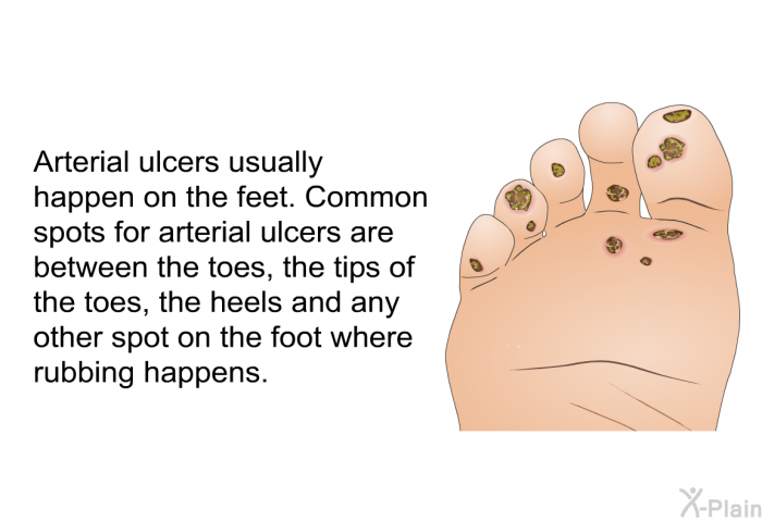 Arterial ulcers usually happen on the feet. Common spots for arterial ulcers are between the toes, the tips of the toes, the heels and any other spot on the foot where rubbing happens.
