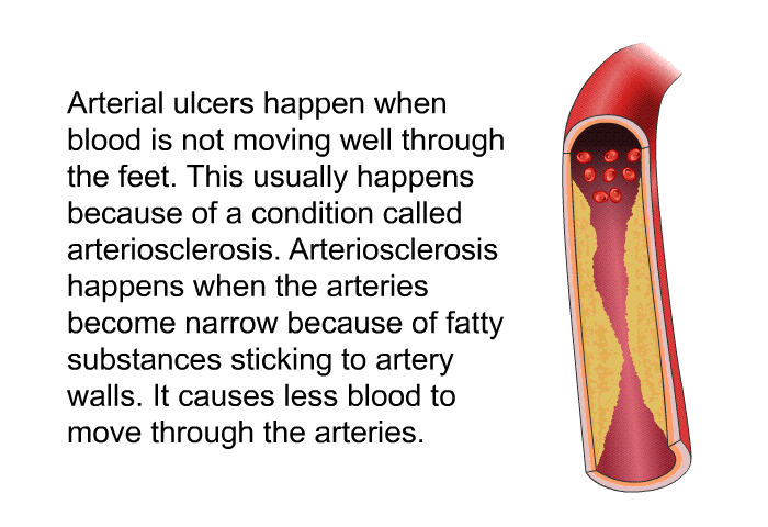 Arterial ulcers happen when blood is not moving well through the feet. This usually happens because of a condition called arteriosclerosis. Arteriosclerosis happens when the arteries become narrow because of fatty substances sticking to artery walls. It causes less blood to move through the arteries.