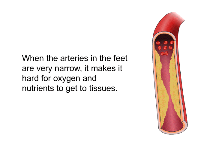 When the arteries in the feet are very narrow, it makes it hard for oxygen and nutrients to get to tissues.
