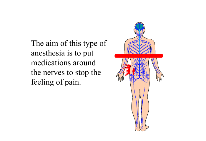 The aim of this type of anesthesia is to put medications around the nerves to stop the feeling of pain.