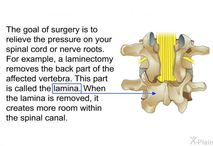 The goal of surgery is to relieve the pressure on your spinal cord or nerve roots. For example, a laminectomy removes the back part of the affected vertebra. This part is called the lamina. When the lamina is removed, it creates more room within the spinal canal.