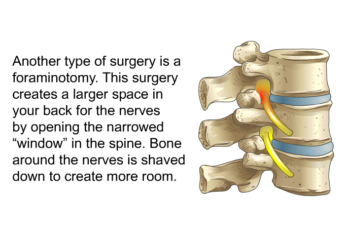 Another type of surgery is a foraminotomy. This surgery creates a larger space in your back for the nerves by opening the narrowed &ldquo;window&rdquo; in the spine. Bone around the nerves is shaved down to create more room.