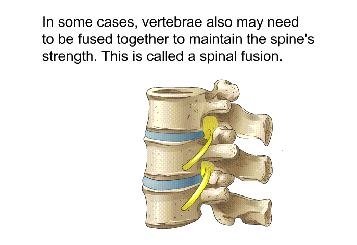 In some cases, vertebrae also may need to be fused together to maintain the spine's strength. This is called a spinal fusion.
