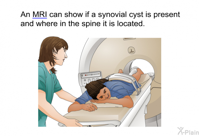 An MRI can show if a synovial cyst is present and where in the spine it is located.