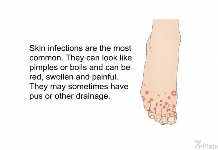 Skin infections are the most common. They can look like pimples or boils and can be red, swollen and painful. They may sometimes have pus or other drainage.