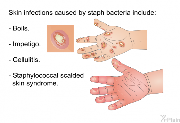 Skin infections caused by staph bacteria include:  Boils. Impetigo. Cellulitis. Staphylococcal scalded skin syndrome.
