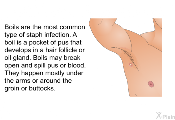 Boils are the most common type of staph infection. A boil is a pocket of pus that develops in a hair follicle or oil gland. Boils may break open and spill pus or blood. They happen mostly under the arms or around the groin or buttocks.