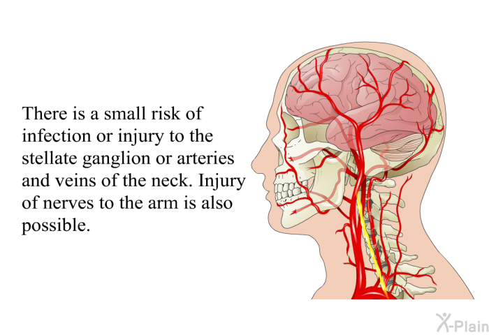 There is a small risk of infection or injury to the stellate ganglion or arteries and veins of the neck. Injury of nerves to the arm is also possible.