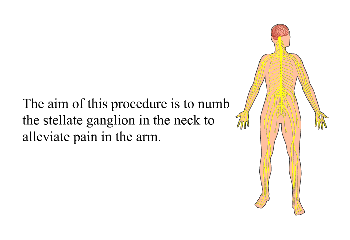 The aim of this procedure is to numb the stellate ganglion in the neck to alleviate pain in the arm.