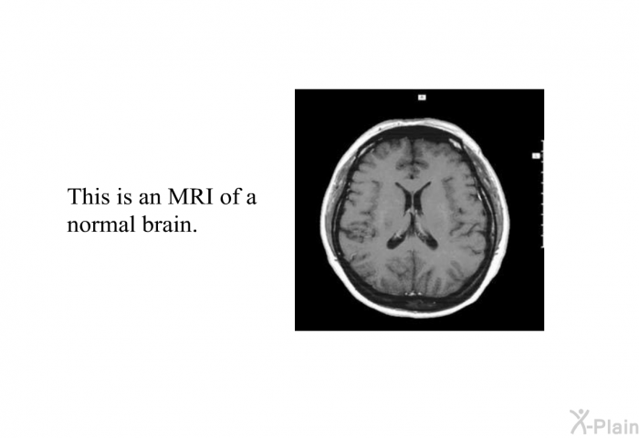 This is an MRI of a normal brain.