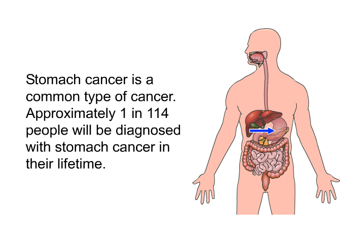 Stomach cancer is a common type of cancer. Approximately 1 in 114 people will be diagnosed with stomach cancer in their lifetime.