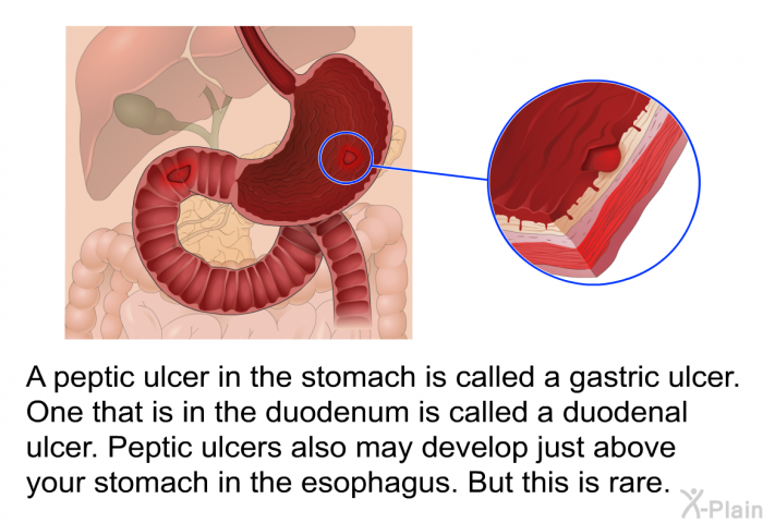 A peptic ulcer in the stomach is called a gastric ulcer. One that is in the duodenum is called a duodenal ulcer. Peptic ulcers also may develop just above your stomach in the esophagus. But this is rare.