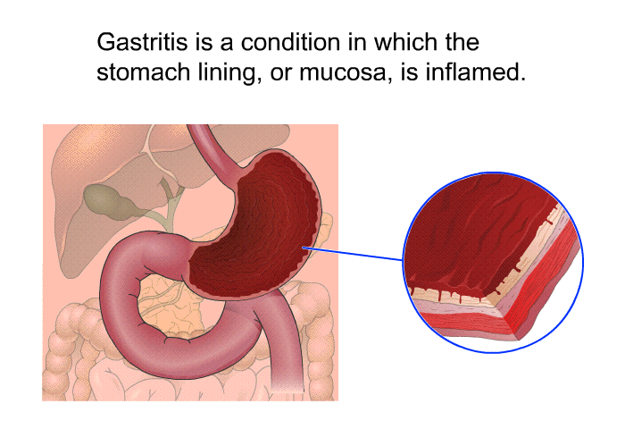 Gastritis is a condition in which the stomach lining, or mucosa, is inflamed.