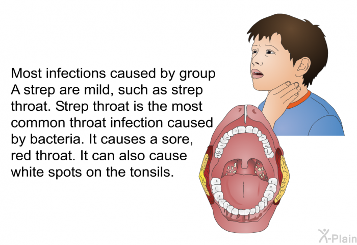 Most infections caused by group A strep are mild, such as strep throat. Strep throat is the most common throat infection caused by bacteria. It causes a sore, red throat. It can also cause white spots on the tonsils.