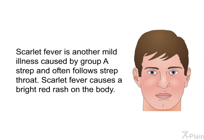 Scarlet fever is another mild illness caused by group A strep and often follows strep throat. Scarlet fever causes a bright red rash on the body.