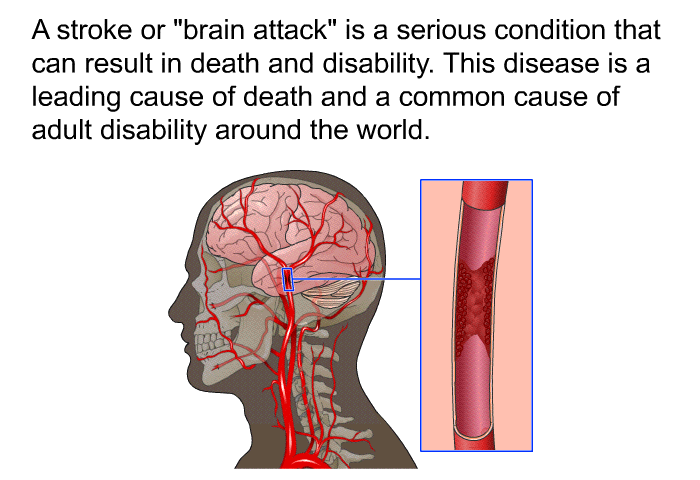 A stroke or “brain attack” is a serious condition that can result in death and disability. This disease is a leading cause of death and a common cause of adult disability around the world.
