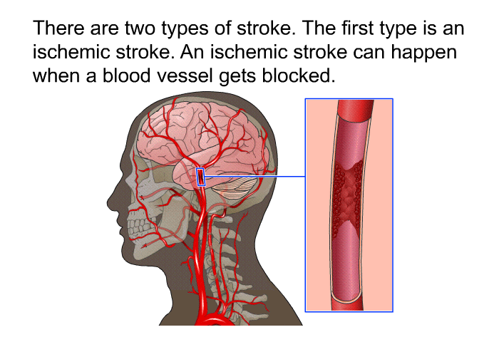 There are two types of stroke. The first type is an ischemic stroke. An ischemic stroke can happen when a blood vessel gets blocked.
