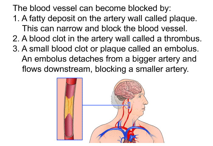 The blood vessel can become blocked by:  A fatty deposit on the artery wall called plaque. This can narrow and block the blood vessel. A blood clot in the artery wall called a thrombus. A small blood clot or plaque called an embolus. An embolus detaches from a bigger artery and flows downstream, blocking a smaller artery.