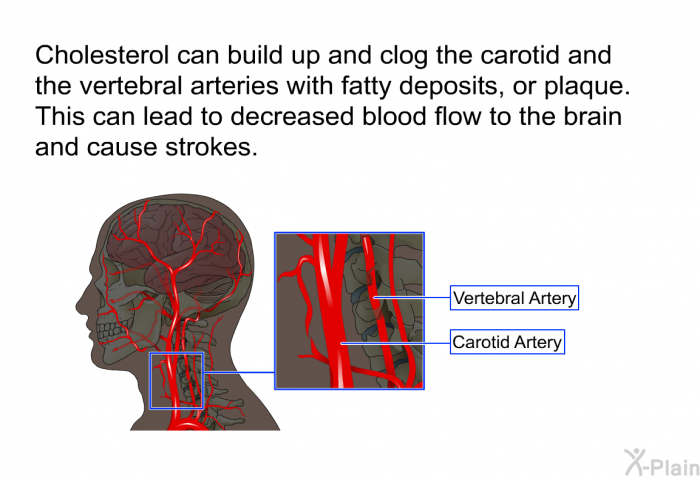 Cholesterol can build up and clog the carotid and the vertebral arteries with fatty deposits, or plaque. This can lead to decreased blood flow to the brain and cause strokes.