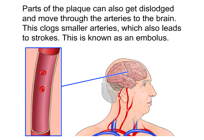 Parts of the plaque can also get dislodged and move through the arteries to the brain. This clogs smaller arteries, which also leads to strokes. This is known as an embolus.