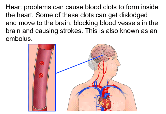Heart problems can cause blood clots to form inside the heart. Some of these clots can get dislodged and move to the brain, blocking blood vessels in the brain and causing strokes. This is also known as an embolus.