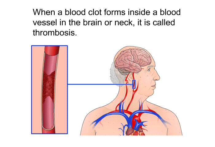 When a blood clot forms inside a blood vessel in the brain or neck, it is called thrombosis.