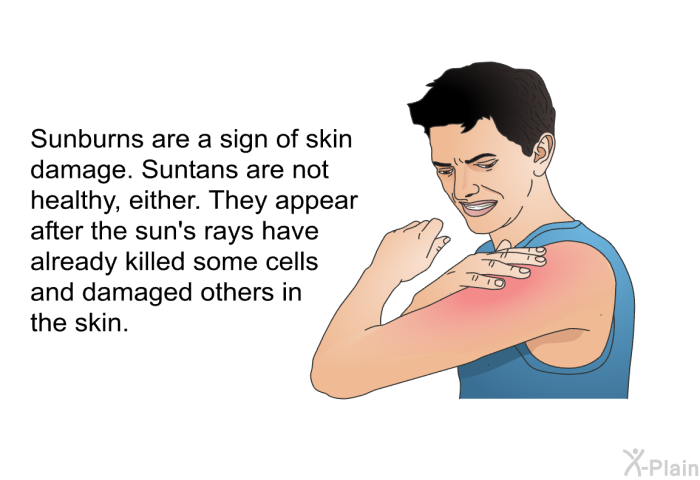 Sunburns are a sign of skin damage. Suntans are not healthy, either. They appear after the sun's rays have already killed some cells and damaged others in the skin.