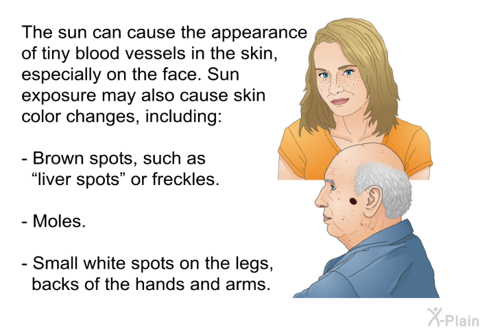 The sun can cause the appearance of tiny blood vessels in the skin, especially on the face. Sun exposure may also cause skin color changes, including:  Brown spots, such as “liver spots” or freckles. Moles. Small white spots on the legs, backs of the hands and arms.