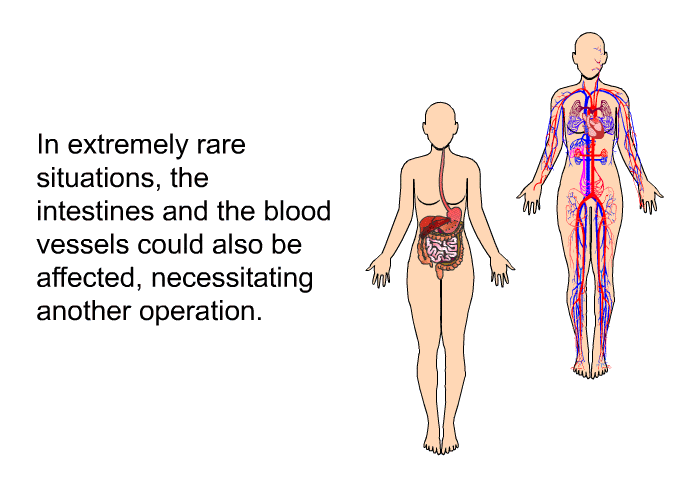 In extremely rare situations, the intestines and the blood vessels could also be affected, necessitating another operation.