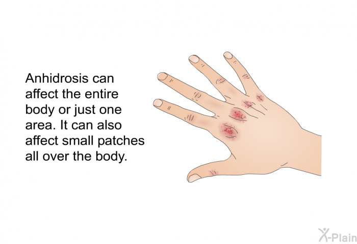 Anhidrosis can affect the entire body or just one area. It can also affect small patches all over the body.