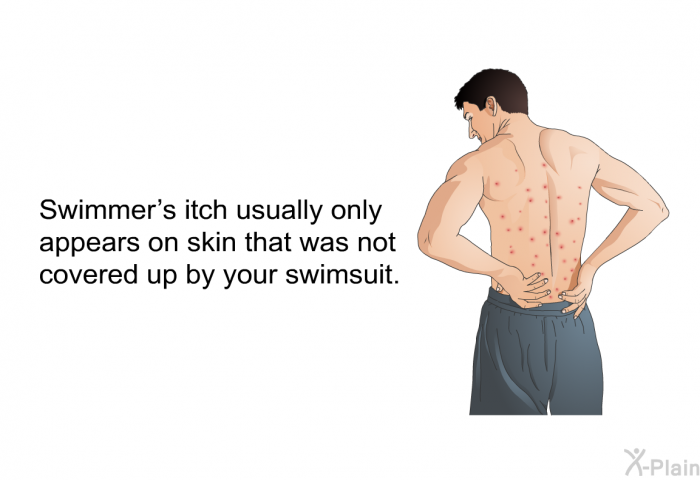 Swimmer's itch usually only appears on skin that was not covered up by your swimsuit.