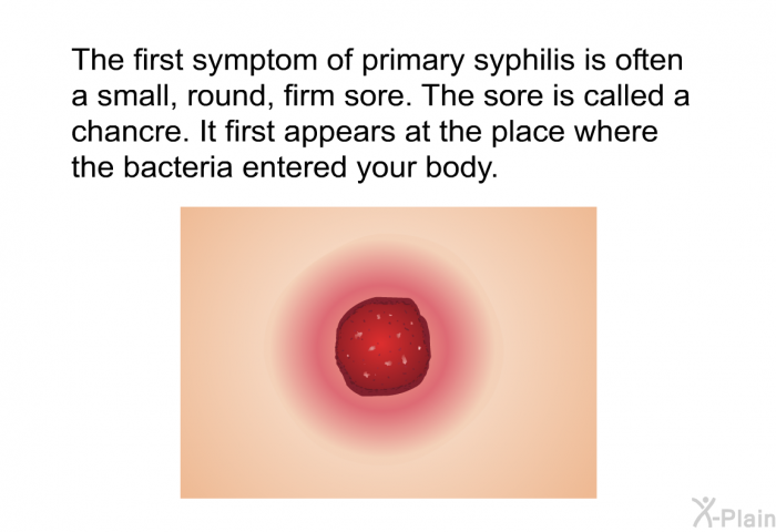 The first symptom of primary syphilis is often a small, round, firm sore. The sore is called a chancre. It first appears at the place where the bacteria entered your body.