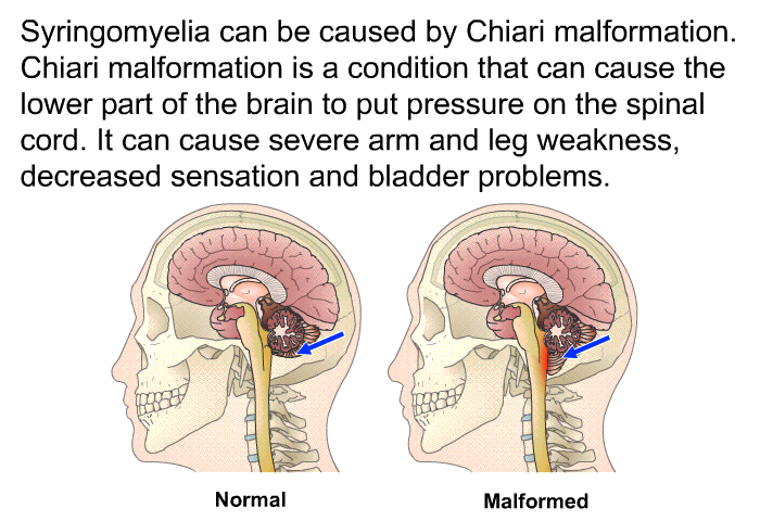 Syringomyelia can be caused by Chiari malformation. Chiari malformation is a condition that can cause the lower part of the brain to put pressure on the spinal cord. It can cause severe arm and leg weakness, decreased sensation and bladder problems.